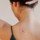 Laser angiome rubis à Paris : comment traiter efficacement les taches rouges sur la peau ?