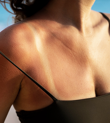 reprendre epilation laser apres les vacances guide pour une rentree sans risque